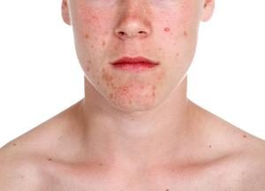 acne-treatment-the-therapy-room-cambridge